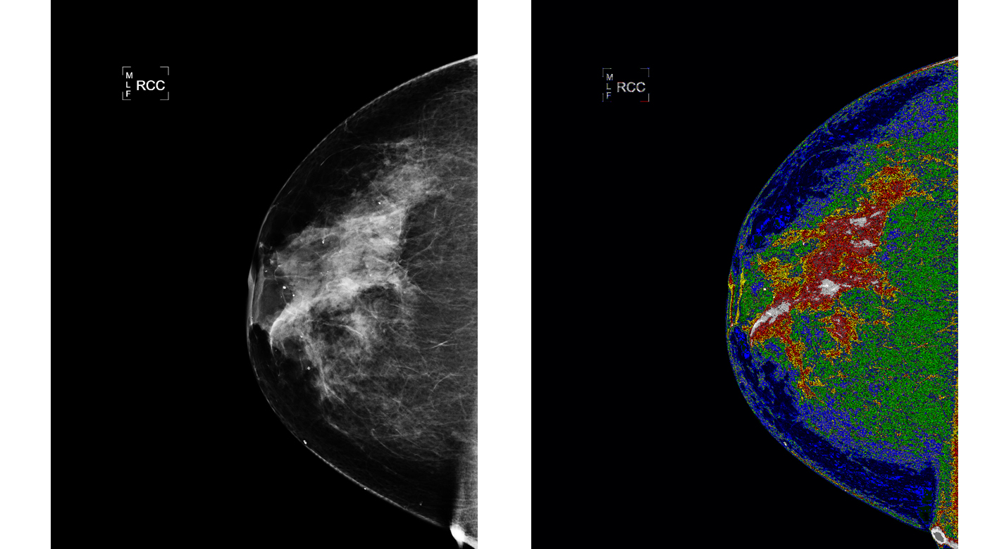 Original mammogram before MED-SEG processing (Left). Credit: Bartron Medical Imaging; and Mammogram, with region of interest (white) labeled (Right), after MED-SEG processing. Credit: Bartron Medical Imaging.
