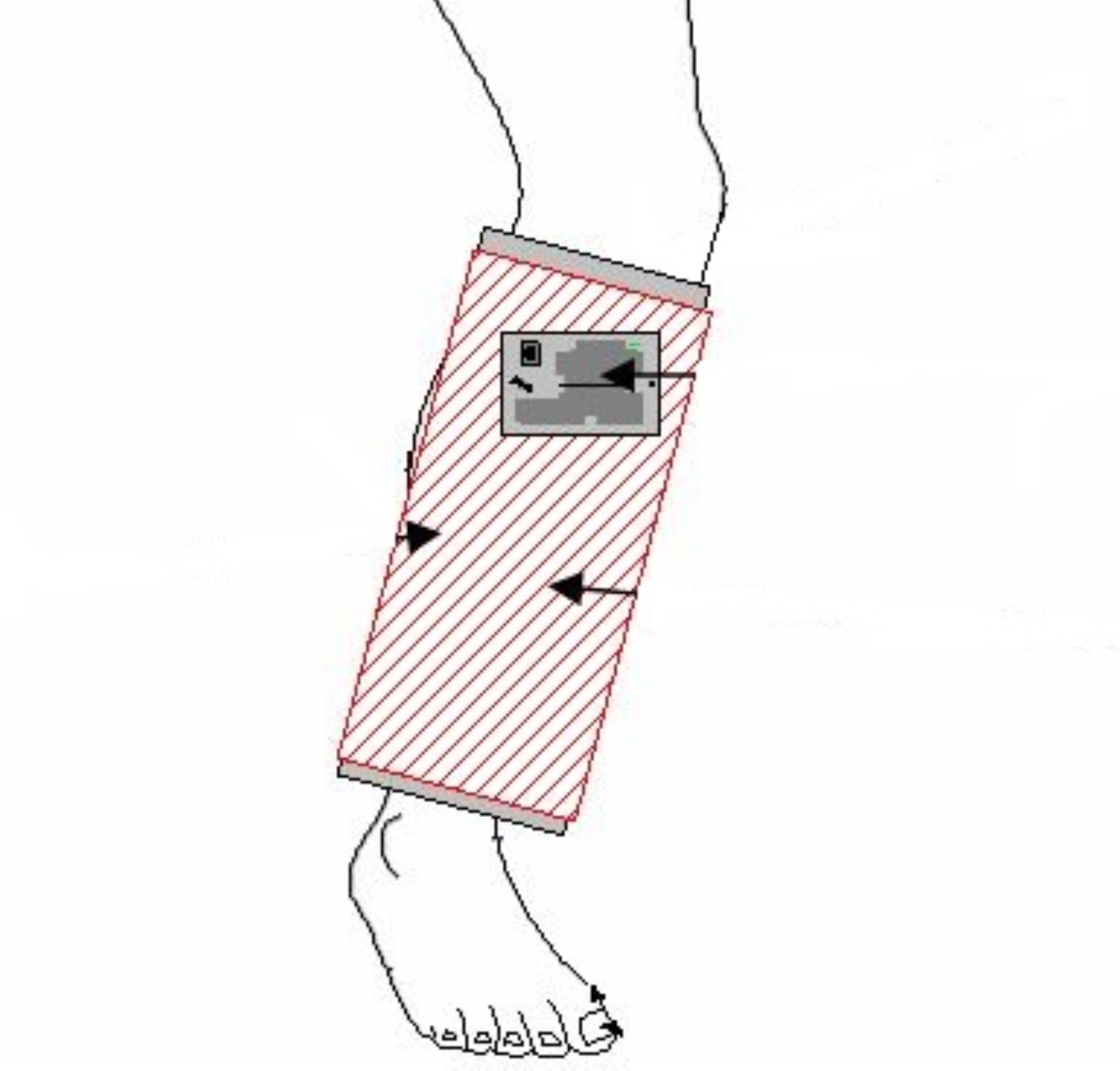 Shown is an illustration of the device sleeve encircling an affected appendage. The device is easily portable and is designed to mend soft tissue and enhance the repair of bone fractures.